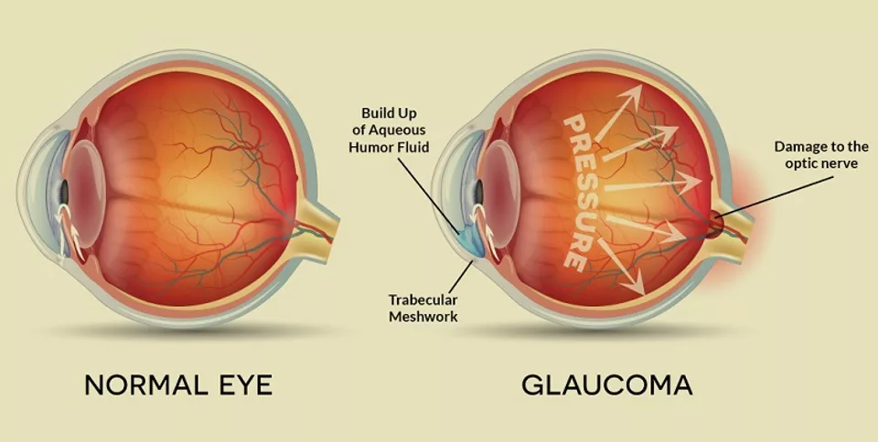 glaucoma 3 png