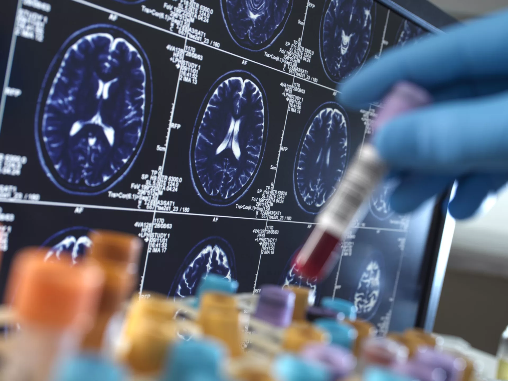 Alzheimer, sangre