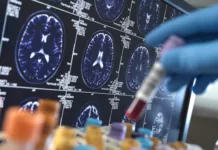 Alzheimer, sangre