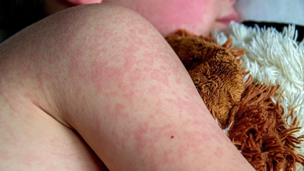 El primer contagio se originó a mediados de febrero en un niño de 8 años que no estaba vacunado. Desde entonces, autoridades ha documentado 761 casos de sarampión en el Estado, una cifra que va en aumento. La Secretaría de Salud de Chihuahua estima que al menos el 90% de las personas que se han contagiado no estaban vacunadas y que alrededor del 15% de las personas que se han contagiado han sido hospitalizadas