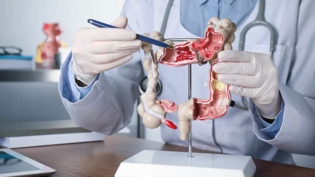 Cáncer de estómago
