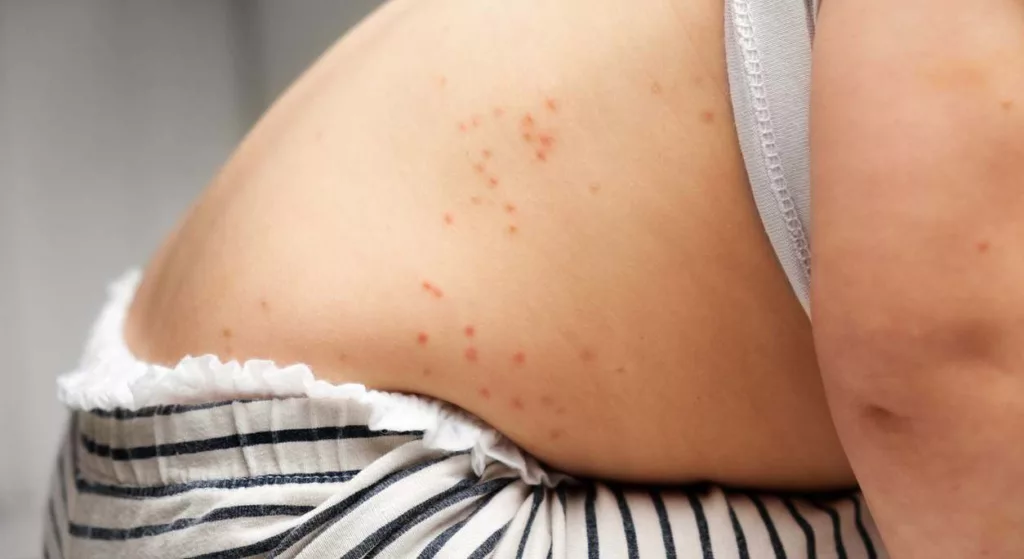 El primer contagio se originó a mediados de febrero en un niño de 8 años que no estaba vacunado. Desde entonces, autoridades ha documentado 761 casos de sarampión en el Estado, una cifra que va en aumento. La Secretaría de Salud de Chihuahua estima que al menos el 90% de las personas que se han contagiado no estaban vacunadas y que alrededor del 15% de las personas que se han contagiado han sido hospitalizadas