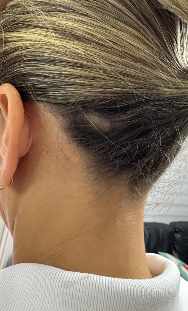 La caída del cabello se ha convertido en una preocupación creciente, especialmente en la población mayor de 35 años, quienes experimentan un debilitamiento de los folículos pilosos. Dermatólogos y esteticistas, señalan que las causas de la caída del cabello obedecen a factores genéticos, problemas de salud y hábitos de vida, sin embargo, coinciden que en la actualidad la principal causa es la presión social y el estilo de vida de los venezolanos, marcado por la crisis económica y social.