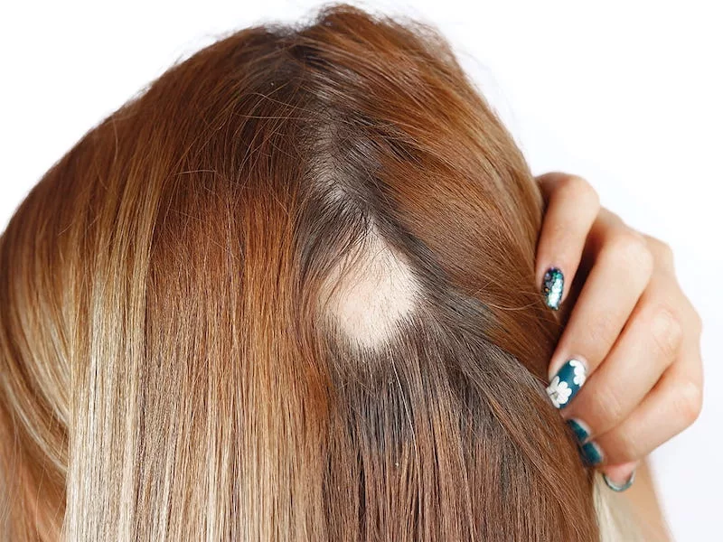La caída del cabello se ha convertido en una preocupación creciente, especialmente en la población mayor de 35 años, quienes experimentan un debilitamiento de los folículos pilosos. Dermatólogos y esteticistas, señalan que las causas de la caída del cabello obedecen a factores genéticos, problemas de salud y hábitos de vida, sin embargo, coinciden que en la actualidad la principal causa es la presión social y el estilo de vida de los venezolanos, marcado por la crisis económica y social.