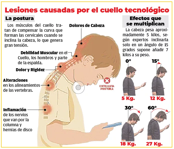 Médicos: jóvenes tienden a sufrir más de síndrome de cuello adelantado