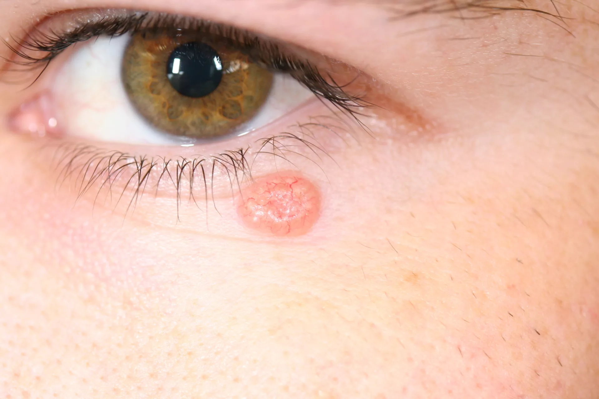 psoriasis y cancer de piel