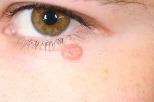 psoriasis y cancer de piel