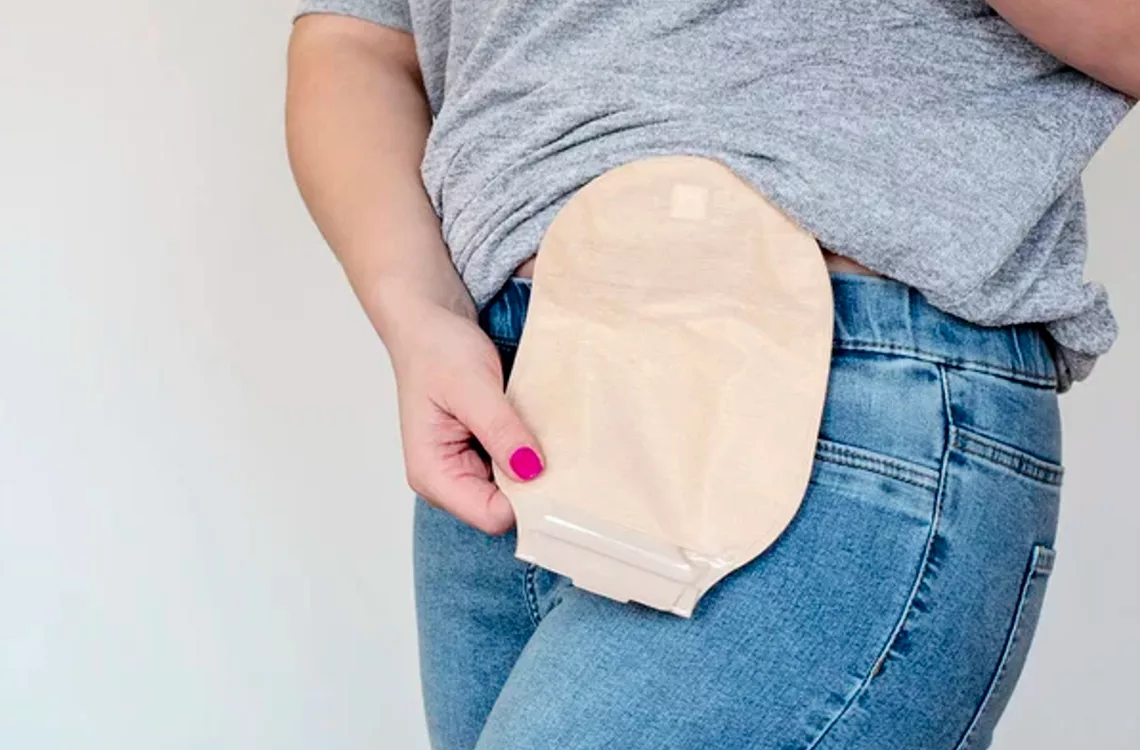 Bolsas de colostomía son difíciles de costear