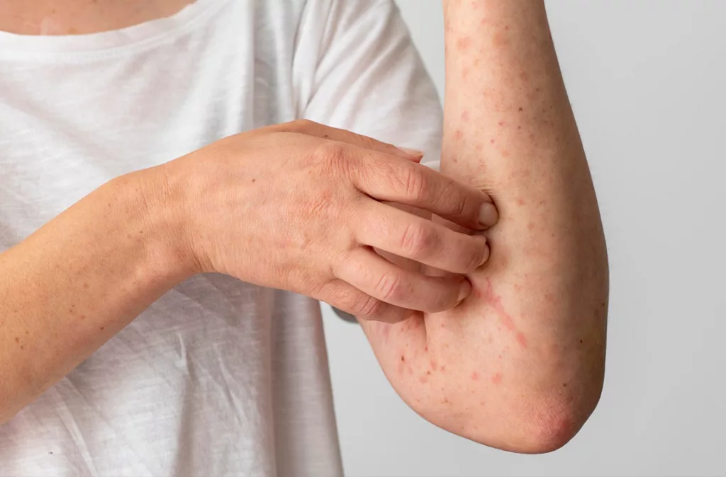 Lupus: una enfermedad que quiere que sus pacientes se vuelvan expertos de ella