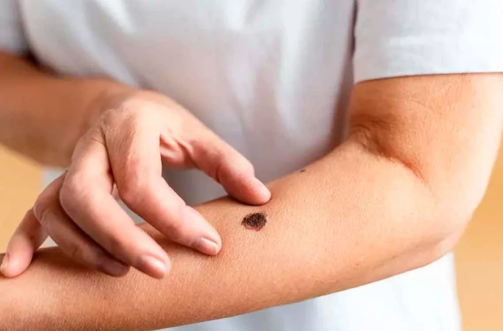 Especialista advierten sobre el riesgo de cáncer de piel por quemaduras solares repetidas