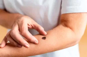 Especialista advierten sobre el riesgo de cáncer de piel por quemaduras solares repetidas