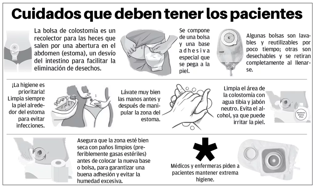 Bolsas de colostomía son difíciles de costear