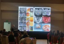 cáncer de cuello uterino