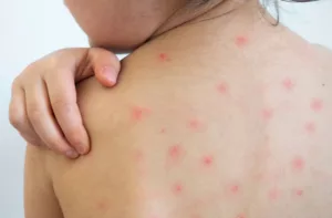 ANM alerta sobre repunte regional de sarampión y baja vacunación en Venezuela