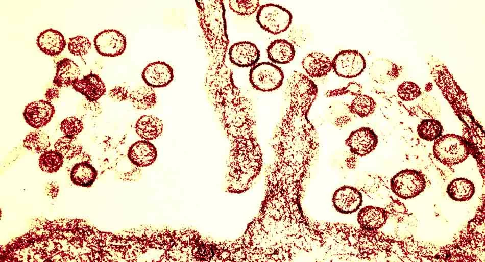 Hantavirus - OMS