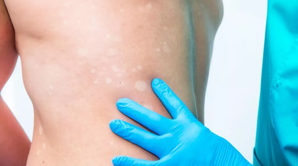 Pacientes con vitíligo enfrentan el desafío del estigma y la depresión