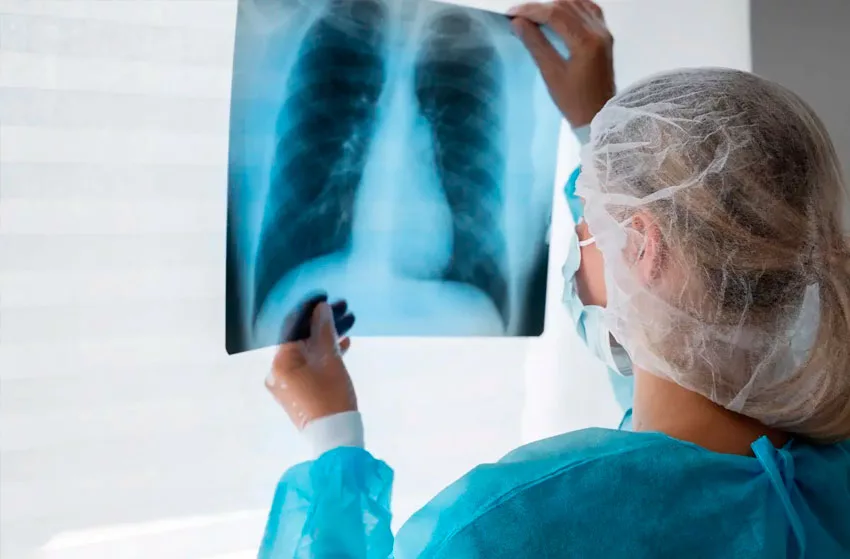 Lara entre los 10 estados con más casos de tuberculosis